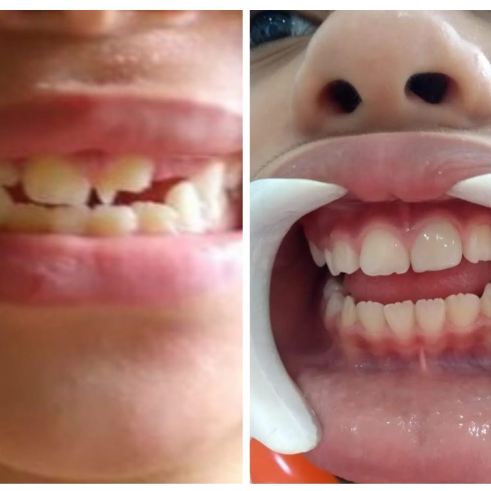 Caso de fratura dentária, com reconstrução em resina.