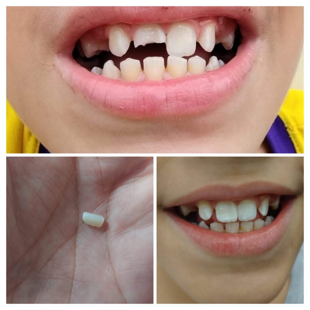 Caso de fratura com colagem do fragmento