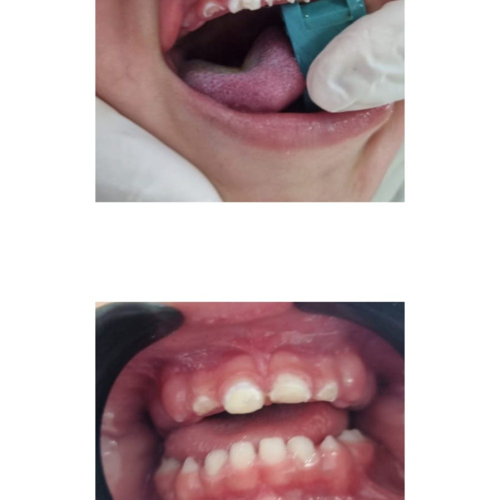 Caso de cárie de 1° Infância (2 anos)