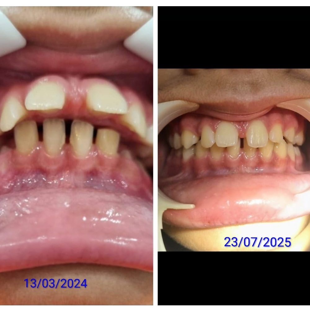 Paciente com 10 anos, com Mordida profunda severa.
