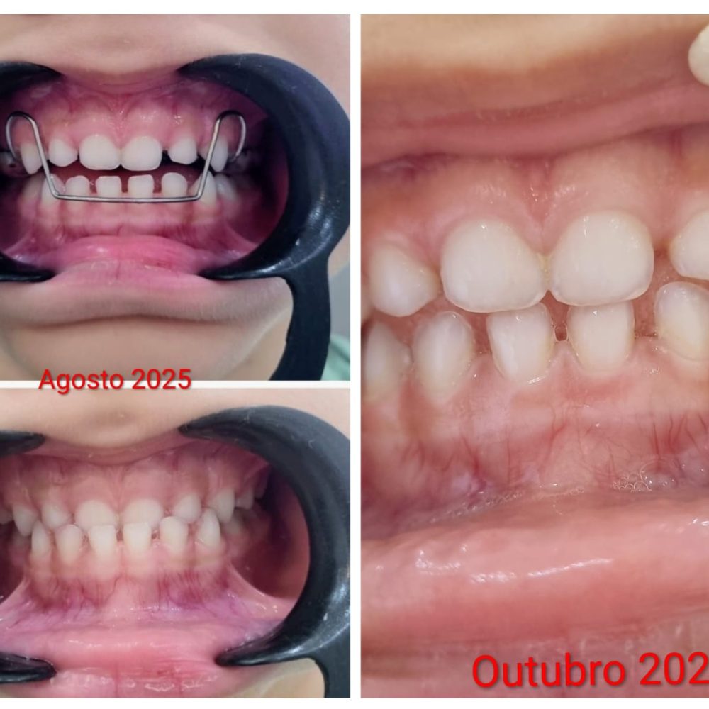 Paciente com 6 anos, Mordida Cruzada Anterior, se não  tratada precocemente esta maloclusão, na fase adulta pode evoluir para Cirurgia Ortognática